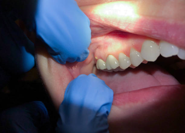 Best Broken or Cracked Tooth Emergency Dentist in Randallstown, MD